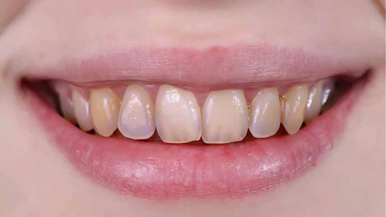 Răng bị mòn men răng muốn bọc răng sứ để bảo vệ răng thật 