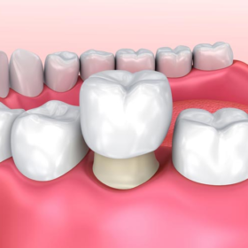 Trồng răng sứ - Mang lại hàm răng hoàn mỹ và sự tự tin cho khách hàng